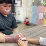 70%嚴重燒傷！30歲青年忍「皮膚撕裂」復健劇痛　半年重拾自主力